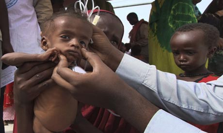 A doctor examines a malnourished child from southern Somalia at refugee camp in Mogadishu