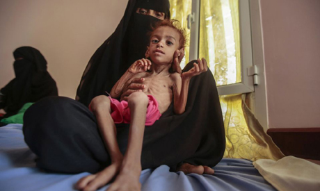 Yemen-  malnutrition- Reuters