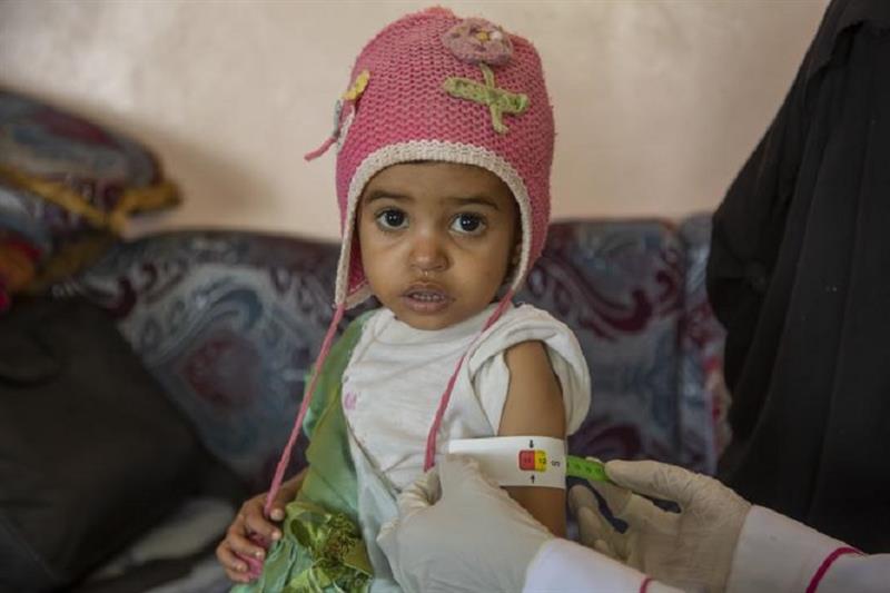 Child faces malnourished in Yemen